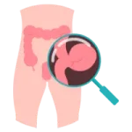 Cirugía de Hernia en Ciudad Obregón