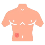 Cirugía de Hernia en Ciudad Obregón