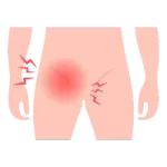 Cirugía de Hernia en Ciudad Obregón