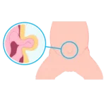 Cirugía de Hernia en Ciudad Obregón