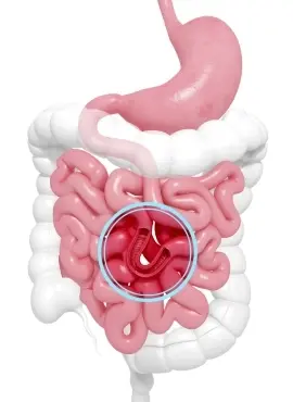 Intestino Perforado en Cd, Obregón